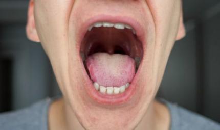 Le 3 infezioni del cavo orale più comuni