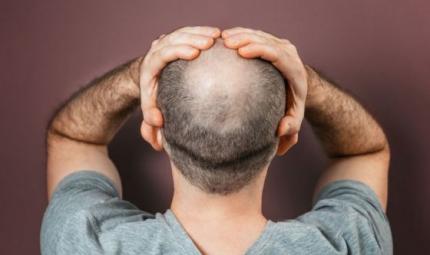 Nuovo trattamento per l'alopecia androgenetica