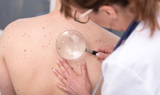 Melanoma: AIFA approva nuova terapia per combatterlo