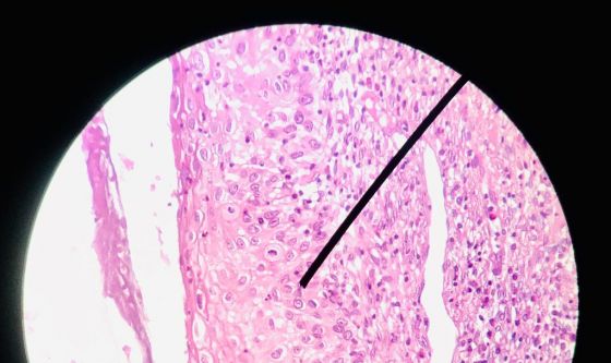 Tumore ovarico, niraparib dopo chemioterapia prima linea