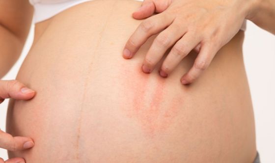 Il prurito in gravidanza: cosa fare?