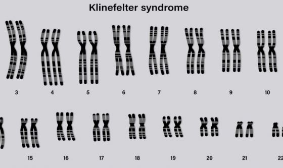 Disordini endocrini: la sindrome di Klinefelter