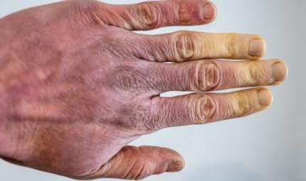 Sindrome di Raynaud: le dita gelide
