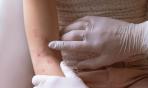 Emollienti per dermatite atopica pediatrica, come scegliere?