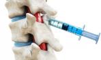 Gestire il dolore: l'anestesia epidurale