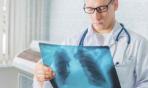 Nuove prospettive di cura per il tumore del polmone