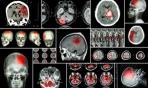 Tumori cerebrali e tecniche radio chirurgiche