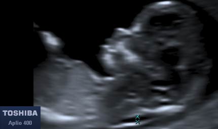 Sett 14, profilo © Dr. Maurizio Longo, DIAGNOSTICA PRENATALE Sett 14, profilo © Dr. Maurizio Longo, DIAGNOSTICA PRENATALE