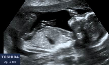 Sett 15, feto © Dr. Maurizio Longo, DIAGNOSTICA PRENATALE Sett 15, feto © Dr. Maurizio Longo, DIAGNOSTICA PRENATALE