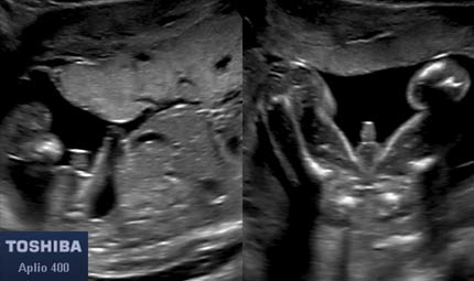 Sett 17, gambe e genitali © Dr. Maurizio Longo, DIAGNOSTICA PRENATALE Sett 17, gambe e genitali © Dr. Maurizio Longo, DIAGNOSTICA PRENATALE