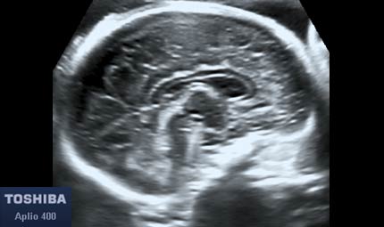 Sett 29, cervello, corpo calloso © Dr. Maurizio Longo, DIAGNOSTICA PRENATALE Sett 29, cervello, corpo calloso © Dr. Maurizio Longo, DIAGNOSTICA PRENATALE