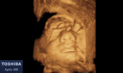 Sett 32, volto e mano 3d © Dr. Maurizio Longo, DIAGNOSTICA PRENATALE Sett 32, volto e mano 3d © Dr. Maurizio Longo, DIAGNOSTICA PRENATALE