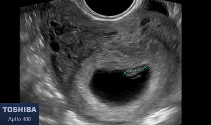 Sett 5, embrione © Dr. Maurizio Longo, DIAGNOSTICA PRENATALE Sett 5, embrione © Dr. Maurizio Longo, DIAGNOSTICA PRENATALE