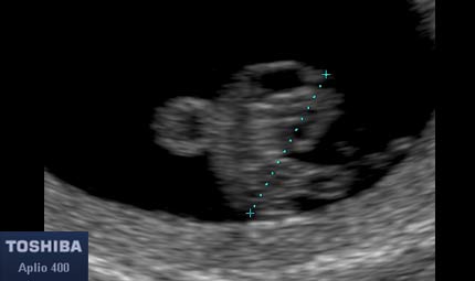Sett 7, embrione © Dr. Maurizio Longo, DIAGNOSTICA PRENATALE Sett 7, embrione © Dr. Maurizio Longo, DIAGNOSTICA PRENATALE