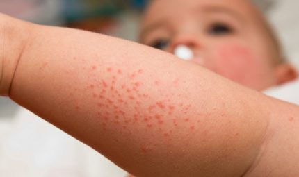Dermatite del bebè: quanto ne sai?