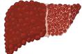 Malattie epatiche