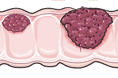 Patologie intestinali